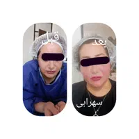 تزریق چربی صورت|خدمات آرایشگری و زیبایی|یاسوج, |دیوار