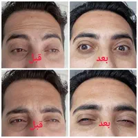 کلینیک تزریق ژل و بوتاکس .فیلر زیر چشم . آنزیم|خدمات آرایشگری و زیبایی|کرج, گوهردشت|دیوار