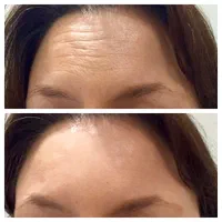 تزریق بوتاکس و فیلر با تخفیف ویژه|خدمات آرایشگری و زیبایی|قزوین, |دیوار