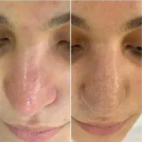 فیشال درمان لک جوش چین و چروک