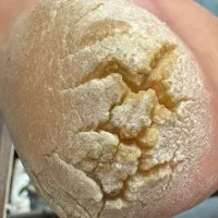 تخفیف ویژه کفسابی درمان ترک پا 270