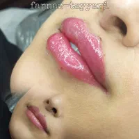 ژل لب گونه چونه زوایه و.. بوتاکس. آنزیم