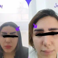 تزریق وتخلیه چربی جراحی پلک لابیا وغیره|خدمات آرایشگری و زیبایی|خرمآباد, |دیوار