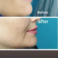 خدمات زیبایی تزریق فیلر ،بوتاکس و لیزر در مطب پزشک|خدمات آرایشگری و زیبایی|قم, نیروگاه|دیوار