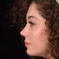 عمل بینی 23تا25/مشاوره رایگان|خدمات آرایشگری و زیبایی|فردیس, طالقانی|دیوار