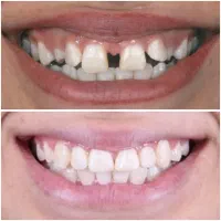 اورتودنسی دندان/۱۰م تخفیف/اقساط بدون سود