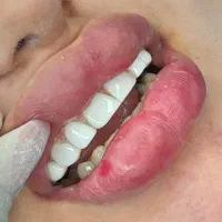 آف ویژه کامپوزیت روکش فول سرامیک