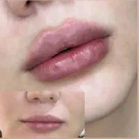 تزریق ژل بوتاکس فیلیر آنزیم