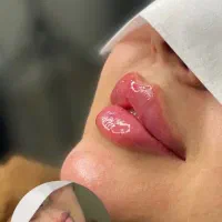 ژل و بوتاکس