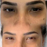 لیزر/ هایفو/ پلاژن تراپی/ رفع ترک پوست/ رفع تیرگی