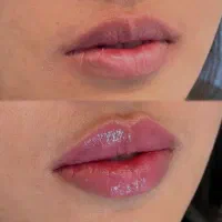 جشنواره ویژه تخفیفی تزریق ژل و بوتاکس و لیزر|خدمات آرایشگری و زیبایی|تهران, نیروی هوایی (پیروزی)|دیوار