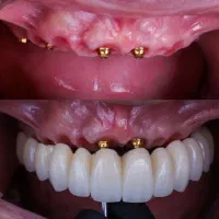 خدمات دندانپزشکی (ایمپلنت) با شرایط ویژه