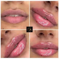 تزریق ژل بوتاکس مزو آموزش