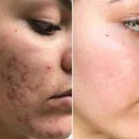 بوتاکس ،فیلر و ژل لب ، لیفت نخ ، انزیم ،مزوتراپی|خدمات آرایشگری و زیبایی|مشهد, جانباز|دیوار