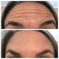 جشنواره ۵۰درصد تخفیف بوتاکس مخصوص خانم ها و آقایان|خدمات آرایشگری و زیبایی|دزفول, |دیوار