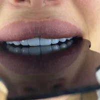 کامپوزیت دندان