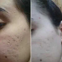 درمان ترک پا|آرایشی، بهداشتی، درمانی|شادگان, |دیوار