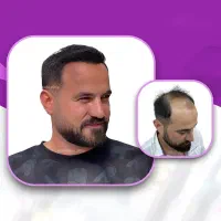 طبق تعرفه وزارت بهداشت کاشت مو و ریش
