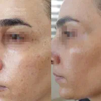 حذف کک مک در یک جلسه بدون زخم و نقاهت