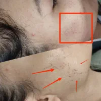 لیزر خال /میخچه زگیل/ ژل بوتاکس|خدمات آرایشگری و زیبایی|قم, صفائیه|دیوار