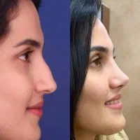 جراحی بینی درتهران/ویژه مراجعین تربت حیدریه/۴۲