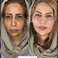 جشنواره تخفیف فیلر فول فیس ژل بوتاکس نخ هایفو