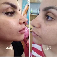 مزو ژل بوتاکس انزیم بینی پلکسرپیرسینگ پاکسازی|خدمات آرایشگری و زیبایی|پرند, فاز ۵|دیوار