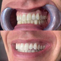 عصب کشی دندان + ترمیم و روکش فقطط ۶۲۵۰