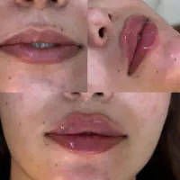 فیلر لب وبوتاکس ،پی آر پی