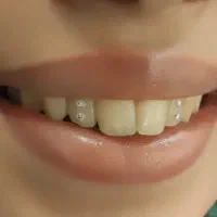 نگین دندان|زیورآلات و اکسسوری|خرمآباد, |دیوار