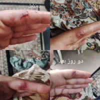 ترمیم زخم سوختگی|آرایشی، بهداشتی، درمانی|قم, حنیف نژاد|دیوار