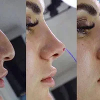 بوتاکس ،فیلر و ژل لب ، لیفت نخ ، انزیم ،مزوتراپی|خدمات آرایشگری و زیبایی|مشهد, جانباز|دیوار