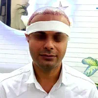 جشنواره کاشت مو