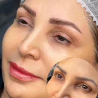 میکرو بلیدینگ و میکروپیگمنتیشن