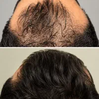کاشت مو با روش SUPER FUE PLUS و متد دبی فقط ۱۵|خدمات زیبایی و سلامت|تهران, چیتگر جنوبی|دیوار
