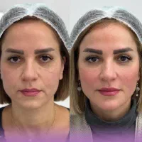 فیلر لب بوتاکس مادلینگ زیرچشم فیلر باسن بیکینی نخ|خدمات آرایشگری و زیبایی|تهران, پاسداران|دیوار