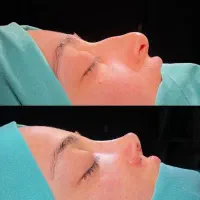 عمل جراحی بینی با قسط سبک 6/900 ماهانه