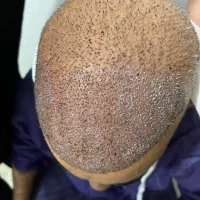 کاشت مو 12 ملیون با ضمانت|خدمات آرایشگری و زیبایی|تبریز, |دیوار