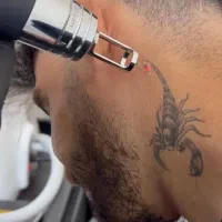 لیزر‌تتو/کیوسوییچ/مدل‌رایگان‌ /تخفیف‌ویژه