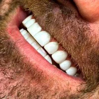 دندانپزشکی/کامپوزیت/تخصصی/