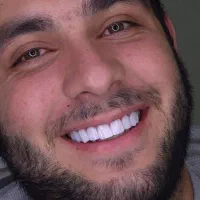 کامپوزیت دندان