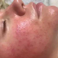 میکرونیدلینگ مزونیدلینگ مزوتراپی در منزل|خدمات آرایشگری و زیبایی|تهران, اختیاریه|دیوار