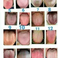 آموزش شناخت بیماریها از روی زبان