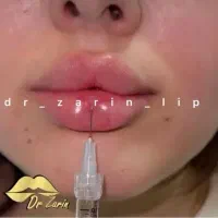 فیلربینی بوتاکس نخ ابرو لب روسیMزاویه ژل گونه پزشک|خدمات آرایشگری و زیبایی|تهران, الهیه|دیوار