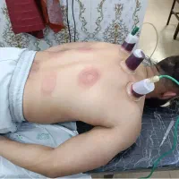 حجامت بادقت و صبر و حوصله در منزل