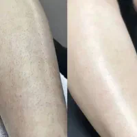 تخفیف لیزرموهای زائدبابهترین دستگاه سال|خدمات آرایشگری و زیبایی|بندرعباس, |دیوار