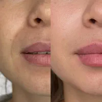 همه خدمات زیبایی ژل فیلر پیرسینگ خال بوتاکس ناخن|خدمات آرایشگری و زیبایی|قم, بنیاد|دیوار