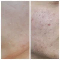 پاکسازی(faical)تخصصی در کلینیک زیبایی اردبیل|خدمات آرایشگری و زیبایی|اردبیل, |دیوار