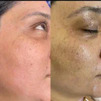 اموزش ساخت کرم ضد لک جوش سفید کننده قوی اصل