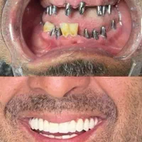 ایمپلنت بدون پیش پرداخت